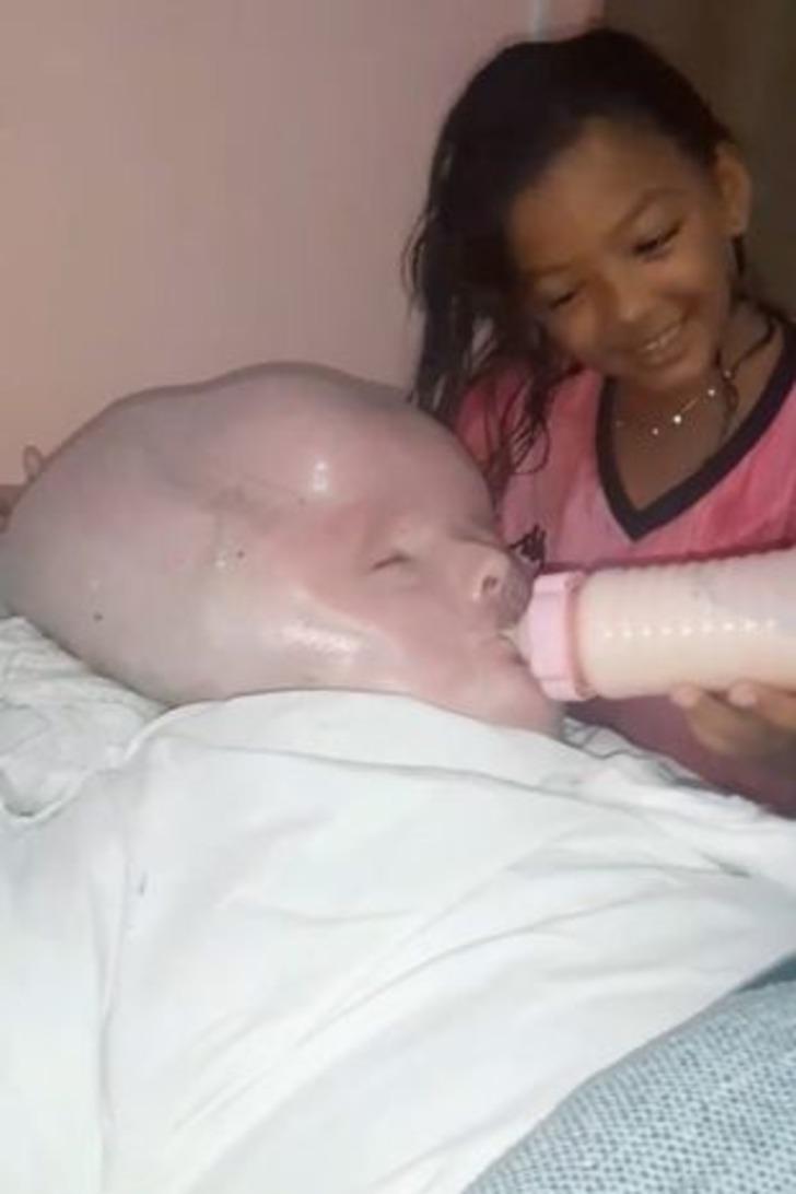 Nadir görülen bir hastalıkla dünyaya geldi! Kafasının büyümesi durdurulamayan bebeğin yaşam mücadelesini annesi böyle paylaştı G1