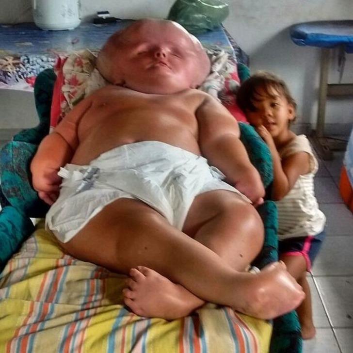 Nadir görülen bir hastalıkla dünyaya geldi! Kafasının büyümesi durdurulamayan bebeğin yaşam mücadelesini annesi böyle paylaştı G3