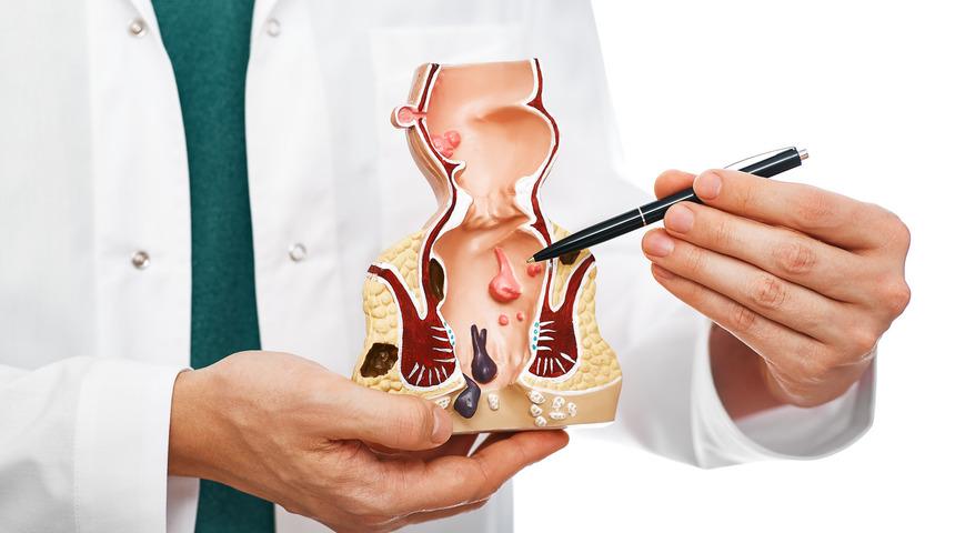 Basur memesi nasıl geçer, ne iyi gelir? Dış basur memesi kendiliğinden geçer mi, neden olur?