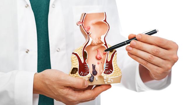 Basur memesi nasıl geçer, ne iyi gelir? Dış basur memesi kendiliğinden geçer mi, neden olur?