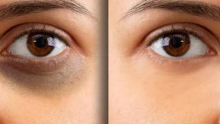 Göz altı morluklarını iki ton açıyor! Aydınlık göz altlarının bakım sırrı