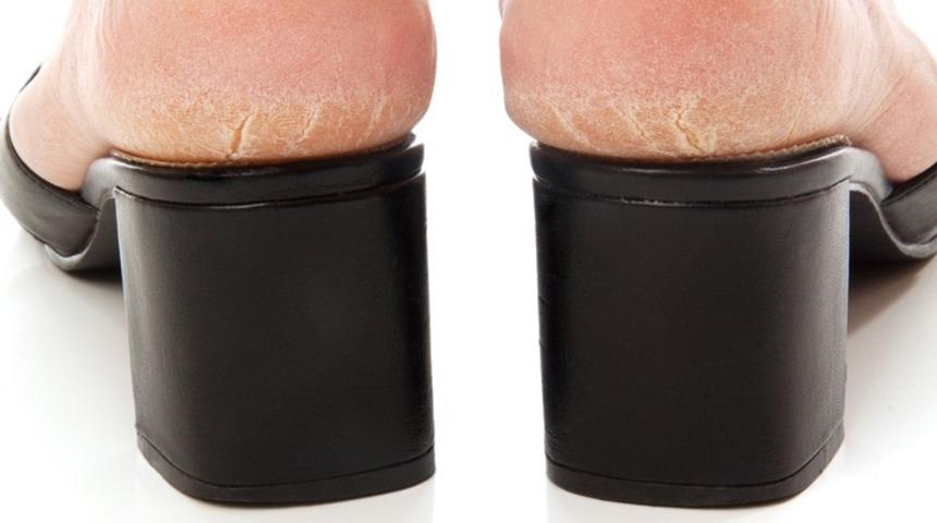 Topuklarınız mı çatlıyor? Merak etmeyin, en iyi tedavi yolu bu kür