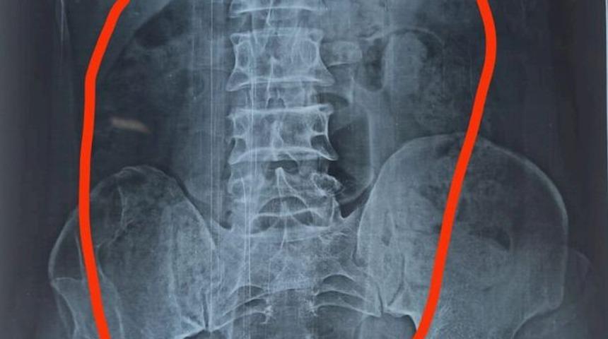 Tıp dünyasını şaşkına çeviren olay! Midesinden plastik şişe çıkarttılar... “Oraya nasıl geldiğini bilmiyorum”