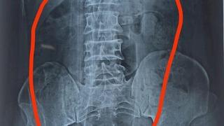 Tıp dünyasını şaşkına çeviren olay! Midesinden plastik şişe çıkarttılar... “Oraya nasıl geldiğini bilmiyorum”