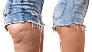 Selülitleri yok eden karışım! Yaza pürüzsüz bacaklarla girmek için...