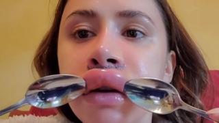 Sadece dudağını büyütmek istedi ama kabusu yaşadı! Dudak dolgusu şişince...