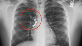 Epilepsi nöbeti geçirdi! Yanlışlıkla yuttuğu takma dişi ciğerine saplandı... Doktorları bile şaşırttı 