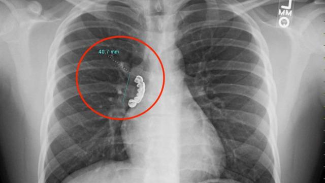 Epilepsi nöbeti geçirdi! Yanlışlıkla yuttuğu takma dişi ciğerine saplandı... Doktorları bile şaşırttı 