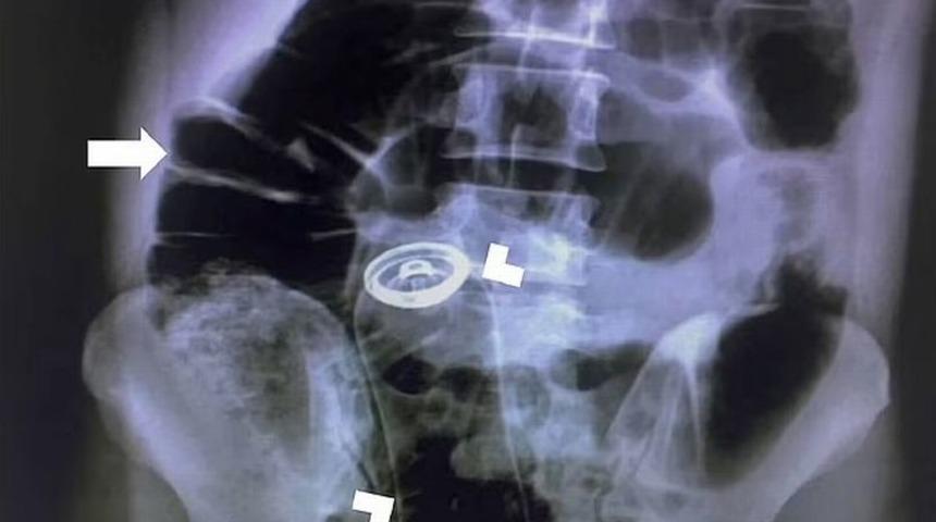 Doktorları bile şaşkına çeviren vaka! Anüsüne deodorant sıkışınca acilen ameliyata alındı...