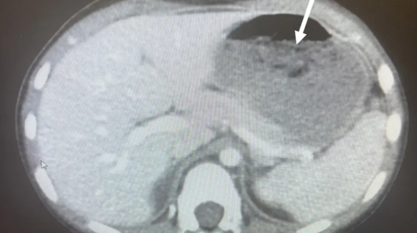 Bunu herkes yapıyor! 40 tane sakız yutan 5 yaşındaki çocuk hastanelik oldu... Röntgen sonuçları doktorları şoke etti