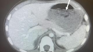 Bunu herkes yapıyor! 40 tane sakız yutan 5 yaşındaki çocuk hastanelik oldu... Röntgen sonuçları doktorları şoke etti