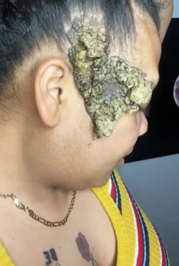 Doğum lekesi zannediyordu! Gerçek bambaşka çıktı... Tüm yüzünü kaplayınca doktor doktor gezerek çare aradı G2