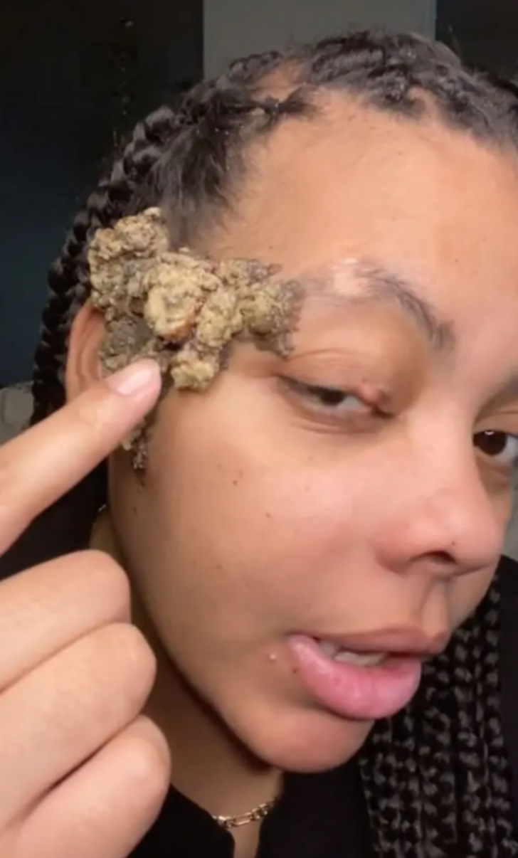 Doğum lekesi zannediyordu! Gerçek bambaşka çıktı... Tüm yüzünü kaplayınca doktor doktor gezerek çare aradı G3