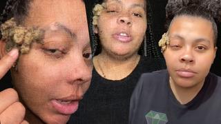 Doğum lekesi zannediyordu! Gerçek bambaşka çıktı... Tüm yüzünü kaplayınca doktor doktor gezerek çare aradı