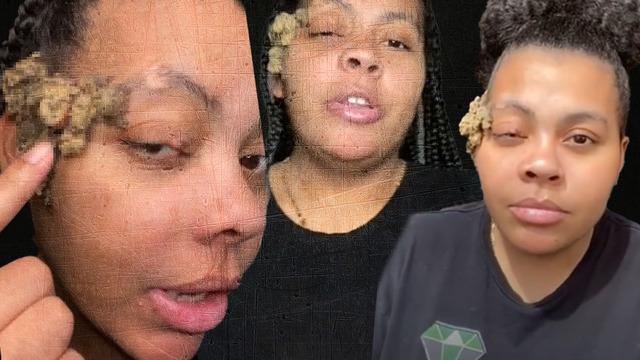 Doğum lekesi zannediyordu! Gerçek bambaşka çıktı... Tüm yüzünü kaplayınca doktor doktor gezerek çare aradı