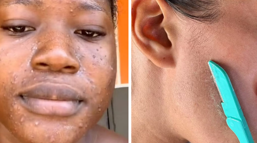 Yüz tüylerinizi almadan önce tekrar düşünün! TikTok trendi cildini mahvetti