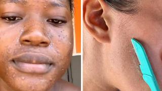 Yüz tüylerinizi almadan önce tekrar düşünün! TikTok trendi cildini mahvetti