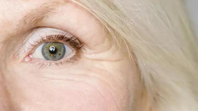 Kırışıklıkları anında yok ediyor! Evde kolayca yapılan botoks etkili kırışıklık giderici krem tarifi