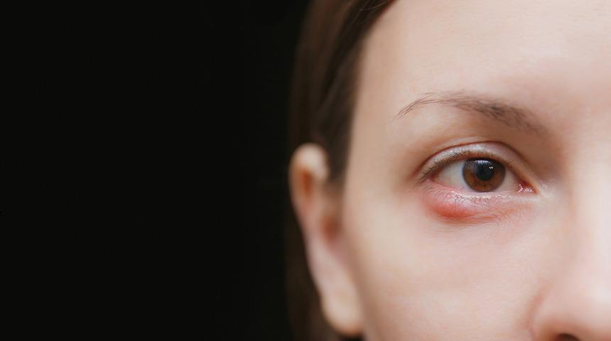 Gözde arpacık nasıl geçer, belirtileri nelerdir? Gözde arpacık neden çıkar, ne iyi gelir?