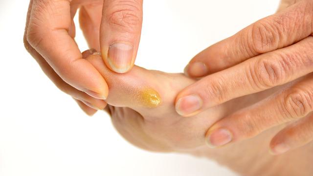 Ayaktaki nasır nasıl geçer, neden olur? Ayak nasırına ne iyi gelir, doğal ve bitkisel tedavi yöntemleri nelerdir?