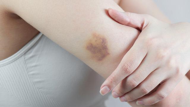 Morluk nasıl geçer, stresten vücutta morluklar nasıl geçer? Morluğa ne iyi gelir, genetik morluklar geçer mi?