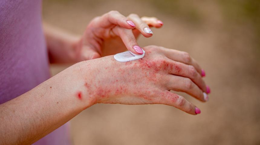 Egzama nasıl geçer, yüzde egzama neden olur? Egzama neden olur, belirtileri nelerdir?