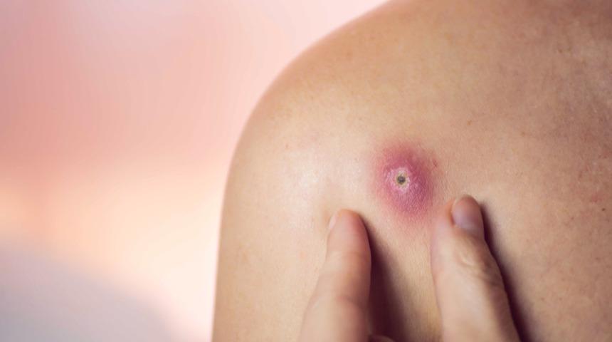 Çıban nasıl geçer, çıban patlatmak zararlı mı? Kör çıban nasıl patlatılır, sürekli çıkan çıban hangi hastalıkların işareti olabilir?