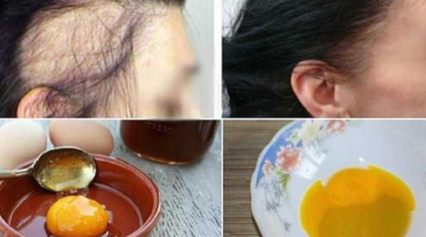 Saç ekimi etkisi yaratıyor! 3 malzemeyle adeta saç fışkırtıyor