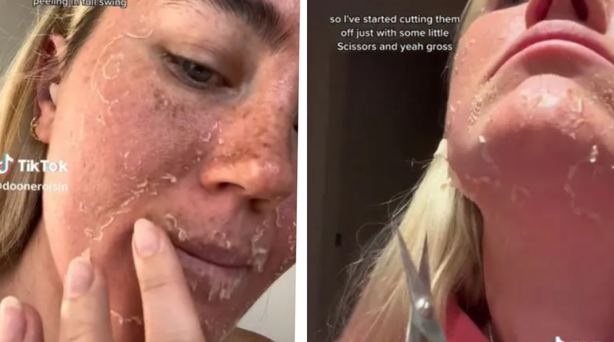 &Ccedil;illerinden kurtulmak i&ccedil;in &ouml;yle bir şey yaptı ki... Cildi stre&ccedil; film gibi soyulmaya başladı