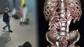 Yer: İstanbul! Karnındaki şişkinlik dikkat çekti, hepsi midesinden çıkarıldı