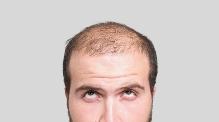 Saç ekiminde DHI tekniğiyle kelliğe son