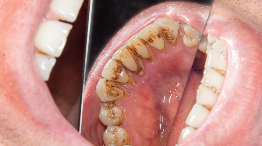 Diş tartarlarını para harcamadan yok ediyor! Diş taşını temizlemenin doğal yolu