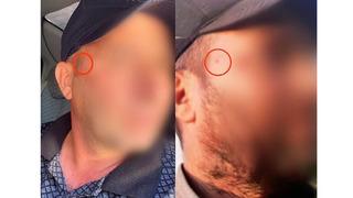 Takip edildiğini öğrendi, yüzündeki beni aldırdı! Şoke eden olay…