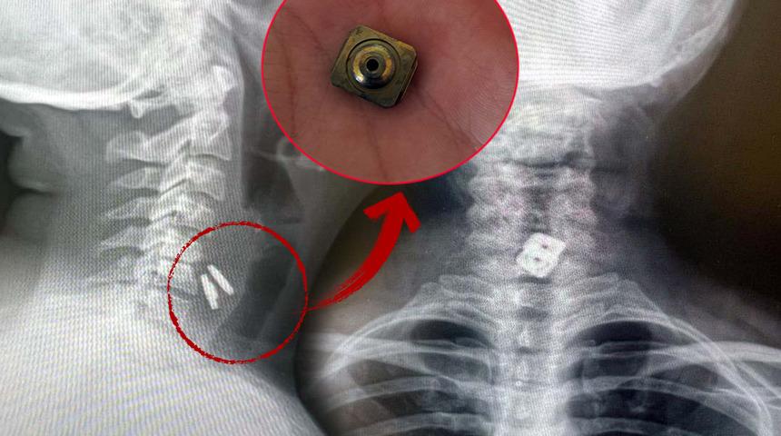 Yemek borusunu yırtıp midesine düştü! 'Bu olay tıp literatüründe görülmedi'