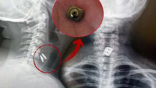 Yemek borusunu yırtıp midesine düştü! 'Bu olay tıp literatüründe görülmedi'