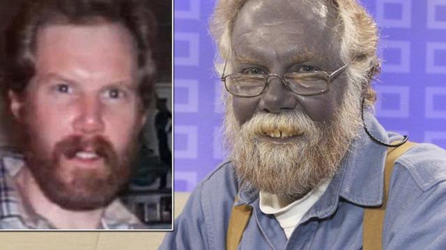 Kullandığı ilaç yüzünden cildi maviye döndü! 'Şirin Baba' lakaplı adam tekrar gündem oldu