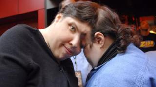 Yapışık ikizlerin cinsellik itirafı olay oldu! “Kardeşim yüzünü çeviriyor”