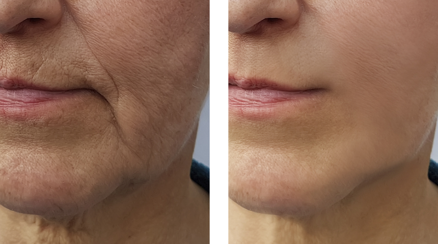 Ciltteki kırışıklıkları silgi gibi yok ediyor! Etkisini bir gecede bile gösteriyor