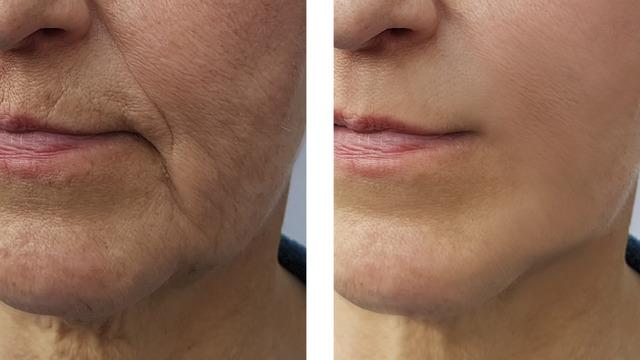 Ciltteki kırışıklıkları silgi gibi yok ediyor! Etkisini bir gecede bile gösteriyor