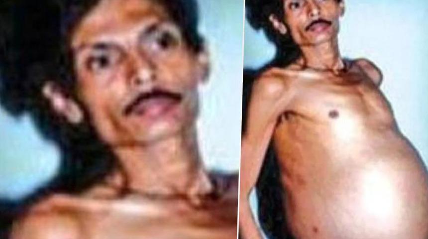 Görenler hamile zannetti! Tam 36 yıl boyunca içinde ikizi varken yaşadı... “Dehşete kapıldık”