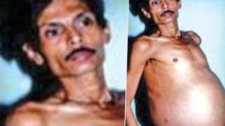 Görenler hamile zannetti! Tam 36 yıl boyunca içinde ikizi varken yaşadı... “Dehşete kapıldık”