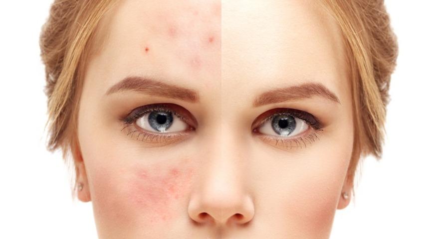 Sivilceyi sirke ile ge&ccedil;irmeyi denediniz mi?