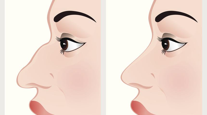 Burun estetiği hakkında doğru bilinen yanlışlar