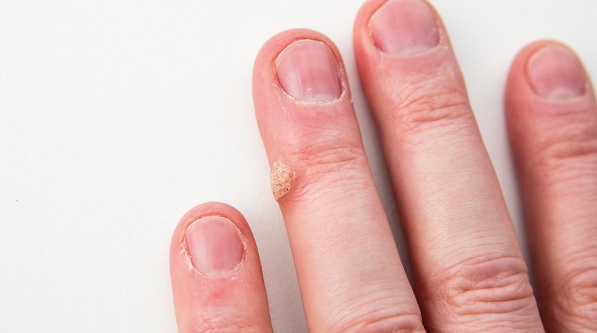 Siğil nasıl geçer, ne iyi gelir? Siğil tedavisi nasıl yapılır, siğil kökü nasıl çıkarılır?