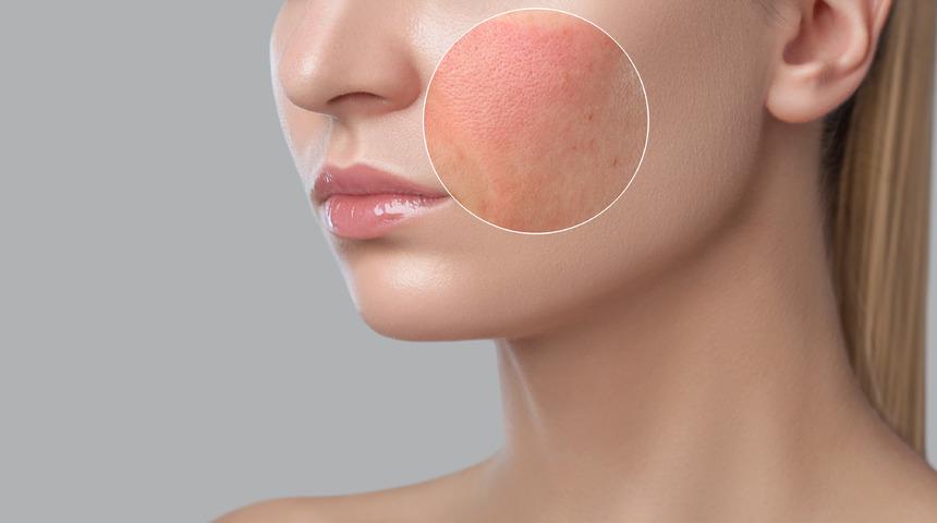 Sivilce izleri nasıl geçer, neden olur? Sivilce izleri için maske ve krem önerileri nelerdir, elma sirkesi iyi gelir mi?