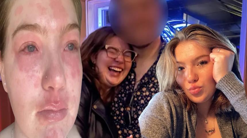 Sosyal medyada itirafı viral oldu! Cinsel ilişkiye girdiğinde kaşınmaya başlıyor... “Erkek arkadaşıma alerjim var”