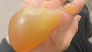 Sadece bisikletle yanından geçti! Eli bir anda davul gibi şişti... “Acıdan bayılmışım”