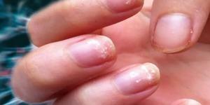 Tırnaklardaki değişime dikkat! Tehlikeli hastalığın belirtisi