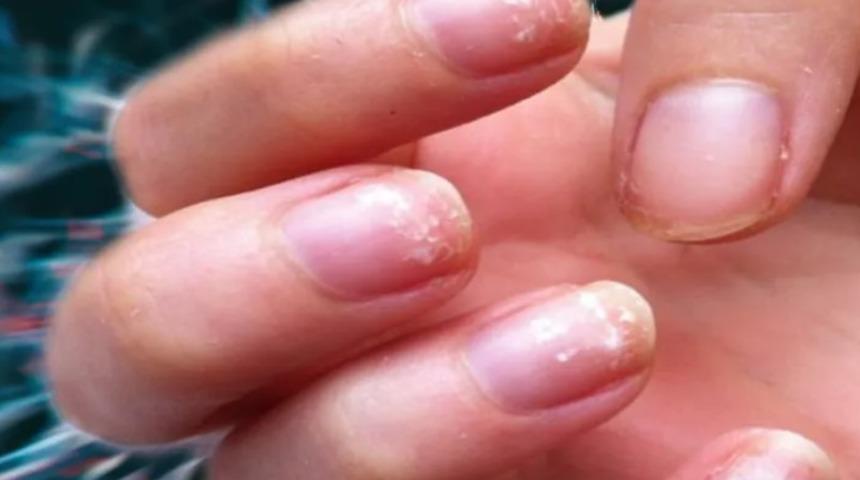 Tırnaklardaki değişime dikkat! Tehlikeli hastalığın ilk belirtisi