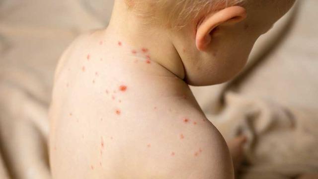 KIZAMIK BELİRTİLERİ: Kızamık belirtileri neler, nasıl bulaşır? Bakan Koca açıkladı: Vakaların yüzde 86'sı İstanbul'da!